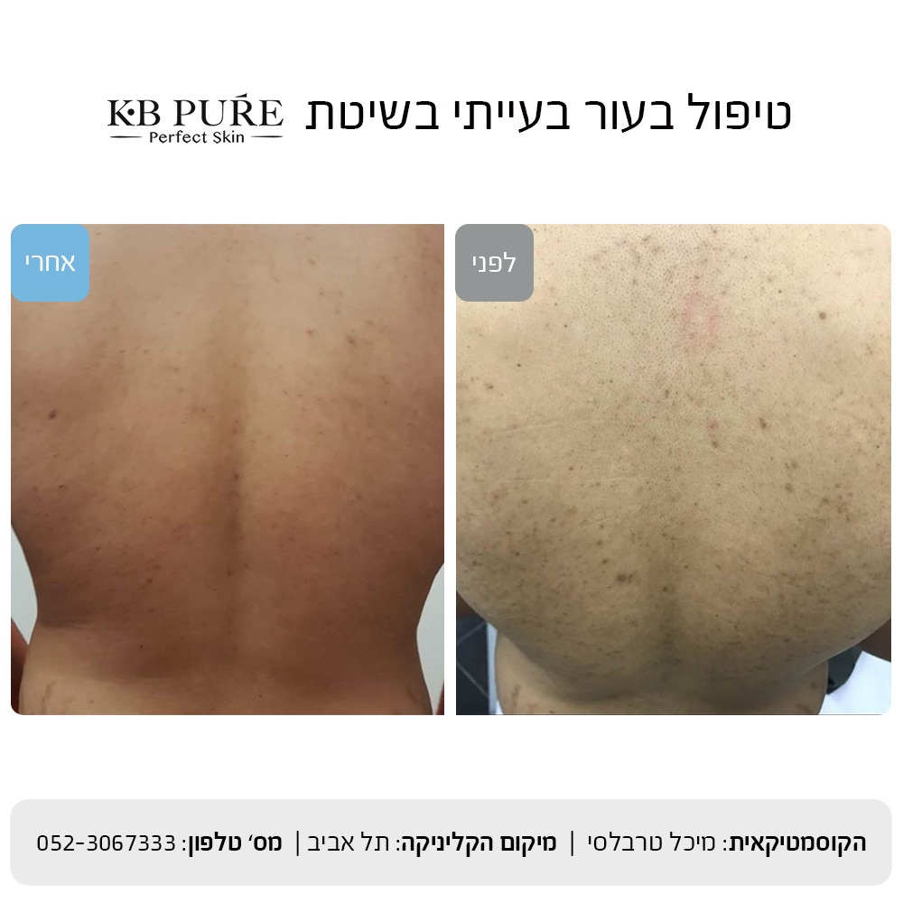 טיפול בעור בעייתי - קוסמטיקאית בלב תל אביב